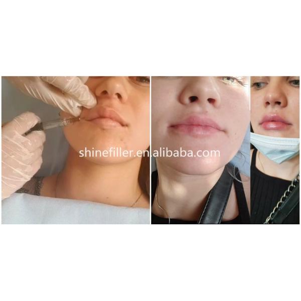 2ml Cross Linked Medical Sodium Hyaluronate Gel Facial Filler Injection