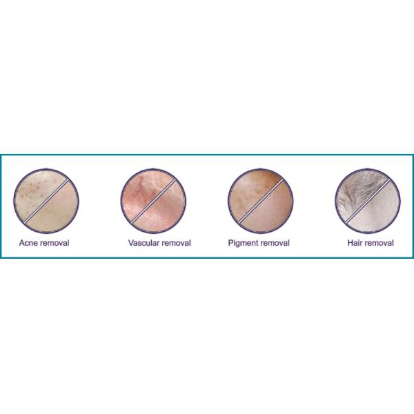 Big Spot IPL Hair Removal Machine Powerful 2 Handlepieces SHR SSR Beauty Equipment