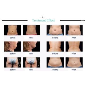 Home 80K Ultrasound Cavitation Body Slimming Machine Tripolar