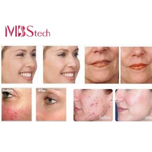 Moisturizing Photon Led Photodynamic Therapy Equipment