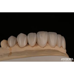 Smooth And Lightweight Dental Veneers Biocompatible And Comfortable For Oral