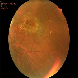 Autoexposure Automated Fundus Camera FFA Non Mydriatic