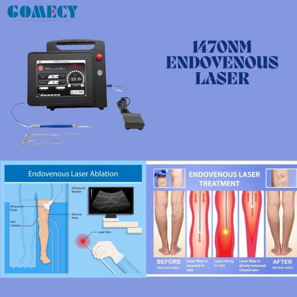 Air Cooling 1470nm Endolift Diode Laser Machine 15w for EVLT, Proctology, PLDD,