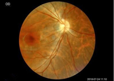 Wifi APP Digital Fundus Camera With Internal Capacity 16GB