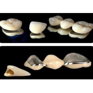 Moderate Translucency Porcelain Fused To Metal PFM Crown , PFM Ceramic Crown