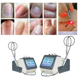 Class IV 980nm Diode Laser For Onychomycosis Therapy