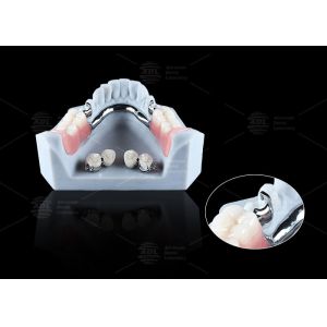 Titanium Dental Implant Ball Attachments Comfortable Secure Denture Retention