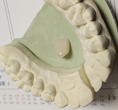 Quality Resin Natural Colour Composite Temporary Crown For Anterior Teeth wholesale