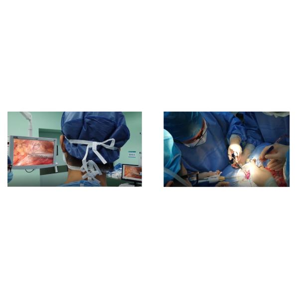 Ultrasonic Surgical Devices Harmonic Scalpel System