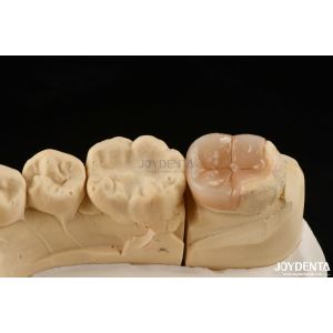 Easy Clean Emax Inlays And Onlays Hypoallergenic Biocompatible Dental Restoratio