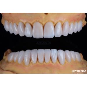 Custom Crafted Emax Porcelain Veneers Smooth Texture Dental Restorations