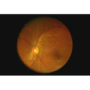 Ophthalmoscope Portable Handheld Fundus Camera Telemedicine Available Video