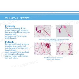 Liposonix HIFU for face and body slimming machine