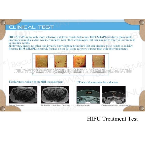 Portable HIFU slimming machine Treatment Test.jpg