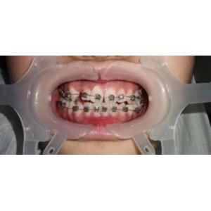 Multi Function Cheek Retractor Clear Large Medium Small For Dental Orthodontic