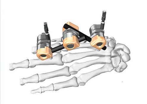 Stable External Fixation System Dissection IV Φ5- Children’S Metacarpale