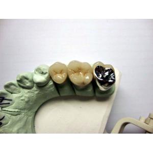 High Biocompatibility PFM Crown Porcelain Fused For Back Teeth Restoration