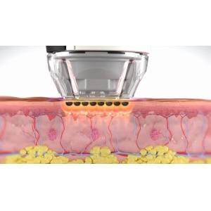 Sublative RF Machine Innovative Skin Resurfacing And Facial Countour Technology
