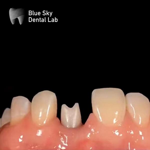 Customized Zirconia Abutment With Titanium Base Blue Sky Implant