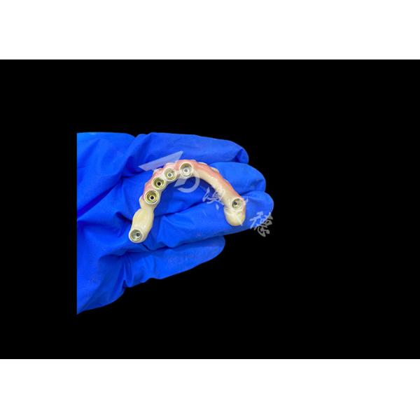 Titanium Abutment and Zirconia Crown Implant Supported Dentures Precision Fit