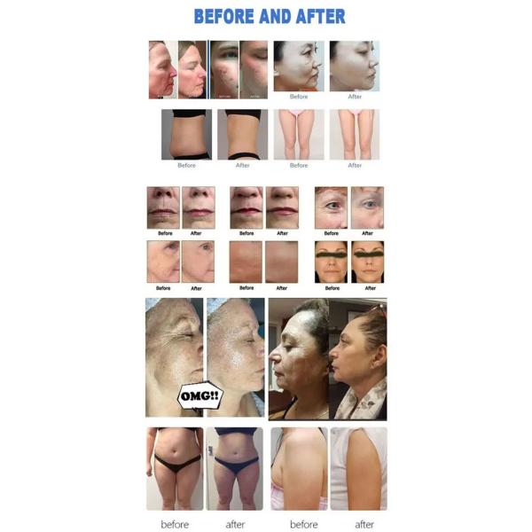 12 Lines High Intensity Focused Ultrasound Device Anti Wrinkle Body Slimming