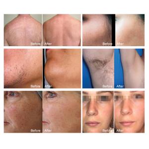 Vertical Soprano Titanium Double Handle 808nm Diode Laser Hair Removal Machine