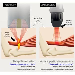 Focused Shockwave Therapy Soft Wave ESWT CE Machine Pain Relief
