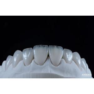 Cheap Natural Looking Emax Porcelain Veneer Comfortable Fit Ultra Thin Emax Veneers for sale
