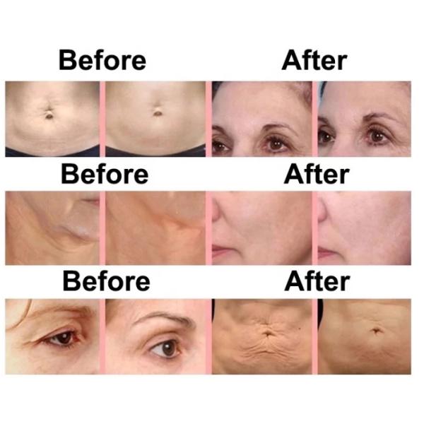 Best Thermagic Flx rf Skin Rejuvenation Machine For Rf Skin Tightening/ Face wrinkle removal