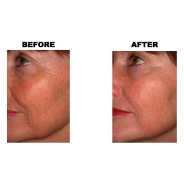 Micro CO2 Fractional Laser Machine , Fractional Carbon Dioxide Laser Resurfacing Equipment