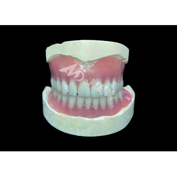Easy-to-Clean Custom Cast Partial Dentures Ideal for Restoring Chewing Ability