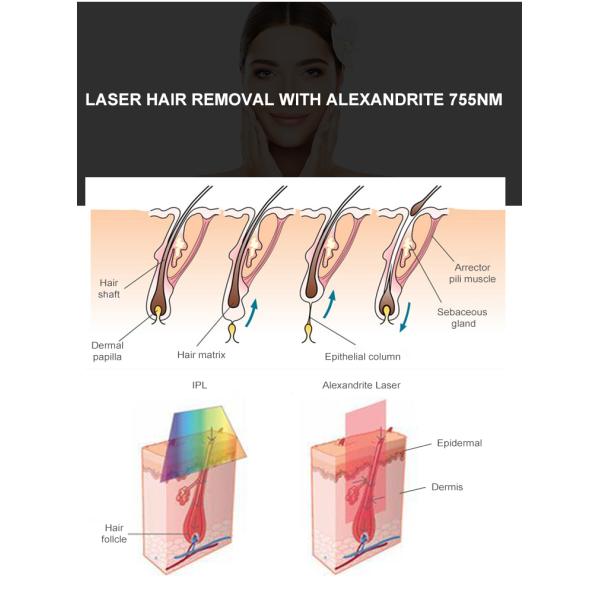 Long pulse q switch 755 1064 nd yag alexandrite laser hair removal machine price