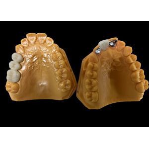 Moderate Translucency Porcelain Fused To Metal PFM Crown , PFM Ceramic Crown