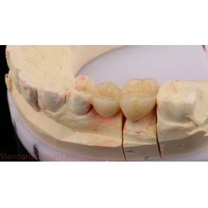 Dental Digital Full Zirconia Crown With 3D Print Model SDL Dental Lab Zirconia