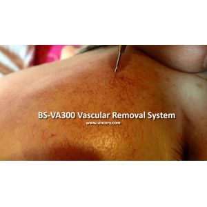 HF Leg Spider Vein / Skin Tag Removal Laser Machine With 0.005mm Tip Diameter