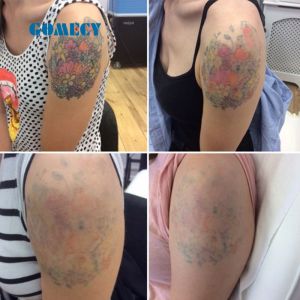 1064nm Spots Size Adjustable Heads Picosecond Laser Machine with Treatment Tips