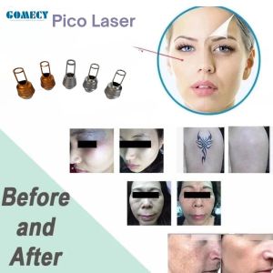 Picosecond Laser Tattoo Removal Q-Switched Laser Pico Laser Picosecond Device