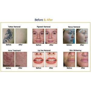 7 Joints Laser Skin Rejuvenation Machine 500-800ps Nd Yag