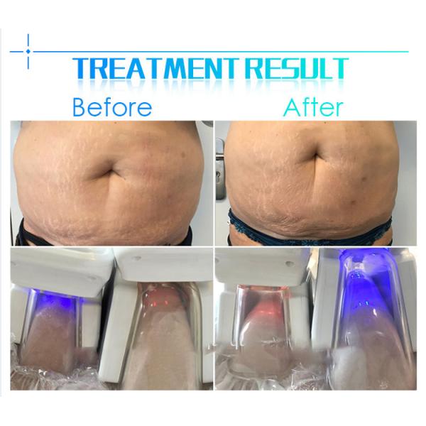 Cryo Cryosurgery Fit Cryotherapy Slimming Machine With Different Handles