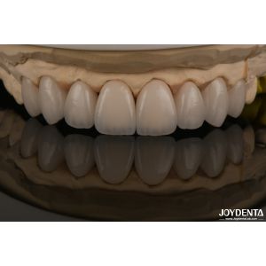 Smooth And Lightweight Dental Veneers Biocompatible And Comfortable For Oral