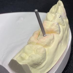 Reinforce Your Restoration with Lock Pink Post Core Technology