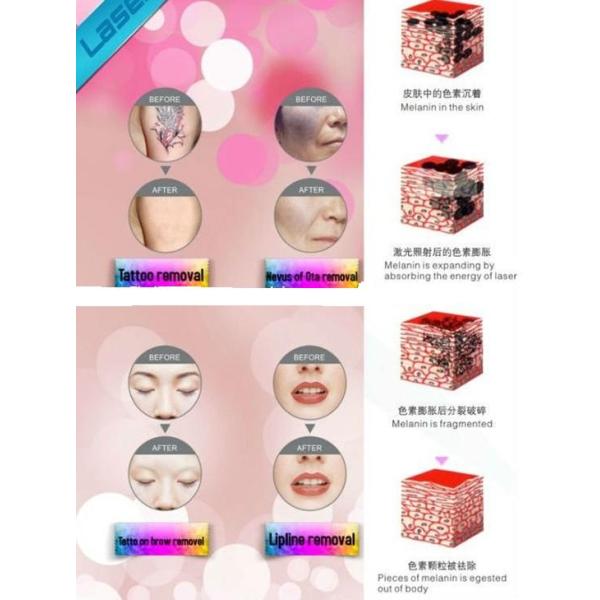 Best professional laser tattoo removal machine with ce approval