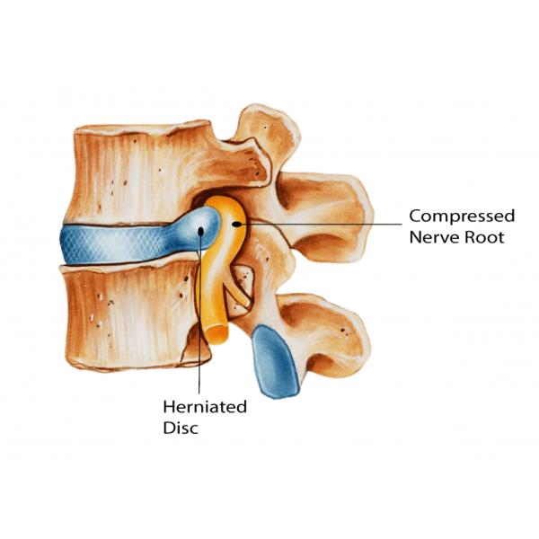 Herniated Intervertebral Disc PLDD Laser