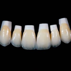High Translucency Emax Porcelain Veneers Crown with Better Materials by Ivoclar