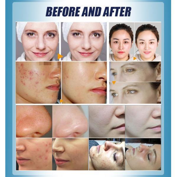 7 In 1 Bubble Beauty Hydrafacial Water Dermabrasion Machine Deep Cleansing