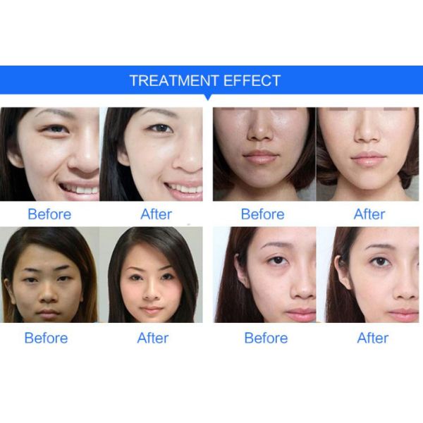 Popular Professional Vital Injector Water Mesogun /Meso Injector Mesotherapy Gun For Skin Renew