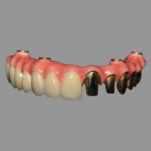 Class 2 Hybrid Malong Full Arch AOX Implant Bridge Titanium Bar with Full Solid