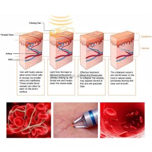980nm 60hz Spider Vein Removal Machine Portable Diode Laser