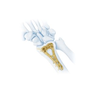 Trauma Multi Axial Palm Distal Radius Fracture Plate II