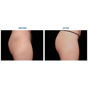 Ems Stimulate Body Sculpt Machine Muscle Buidling Neo Muscle Sculpt Machine